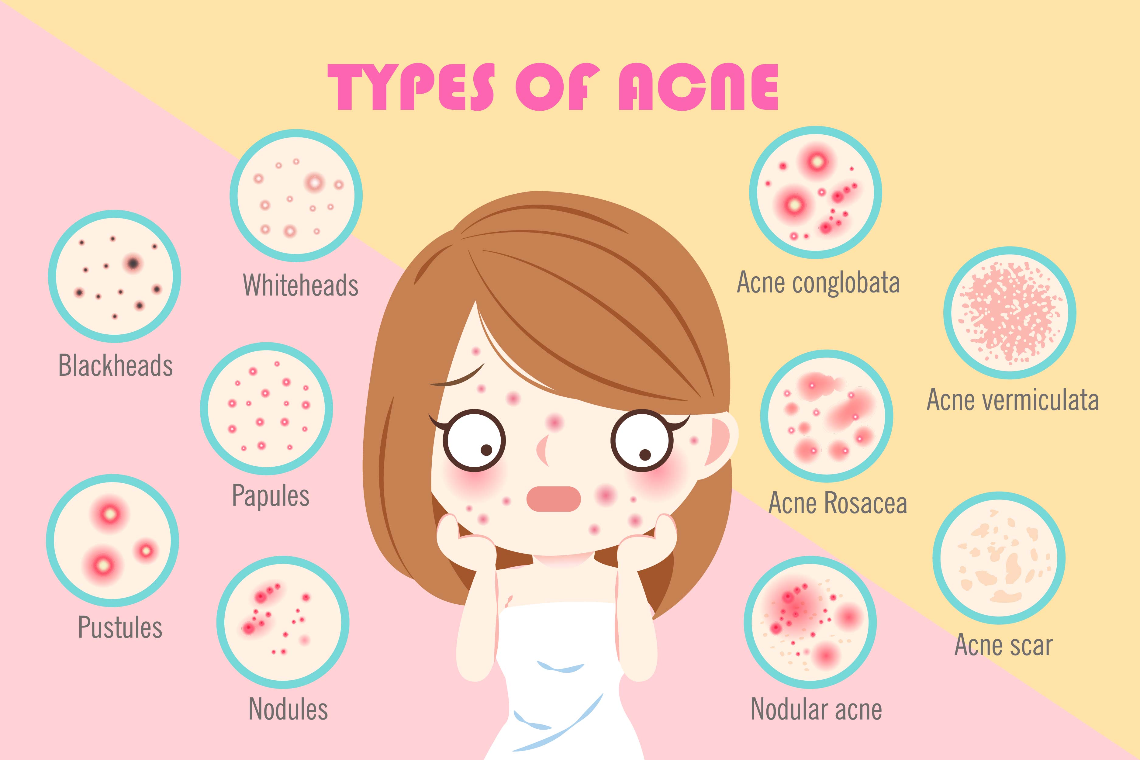 Chin acne sale