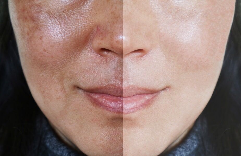 dull skin, dry skin