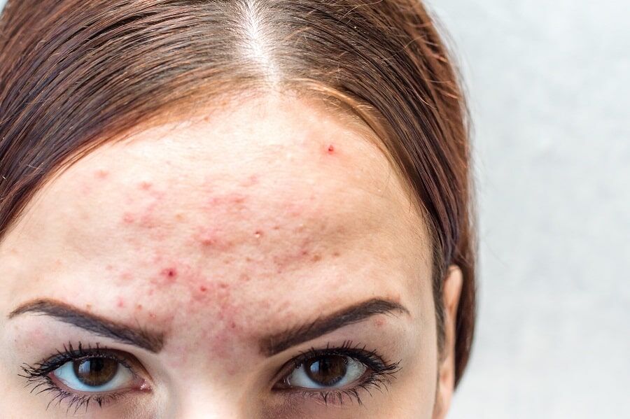 Pimples on forehead What are the Causes Treatments