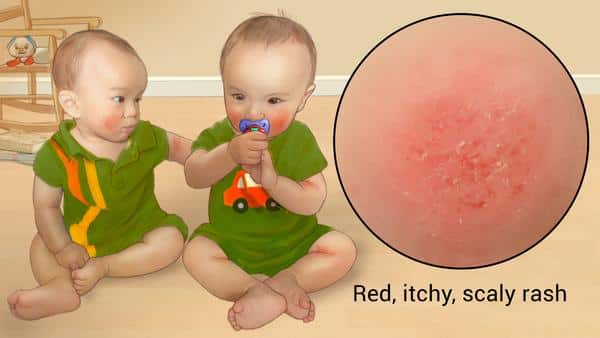 atopic-dermatitis