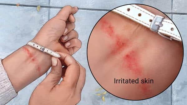 dermatitis tips and treatment
