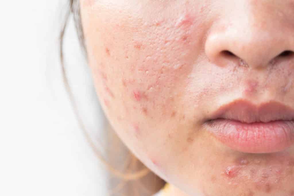 muhase, acne