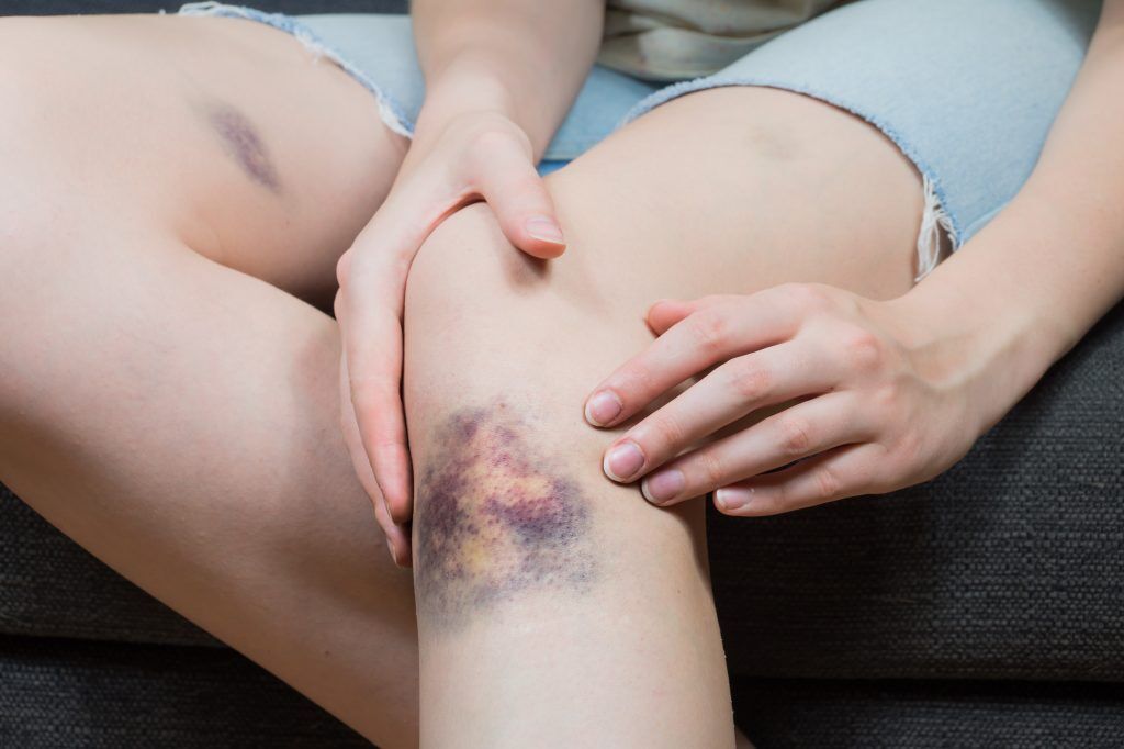 unexplained leg bruising